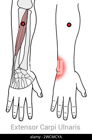 Extenseur Carpi Ulnaris : points déclencheurs myofasciaux et localisations douloureuses associées Banque D'Images
