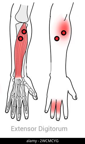 Extenseur Digitorum : points déclencheurs myofasciaux et localisations douloureuses associées Banque D'Images