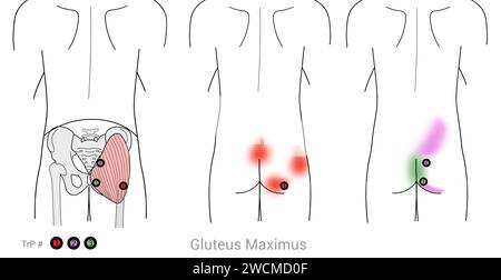 Gluteus Maximus : points déclencheurs myofasciaux et localisations douloureuses associées Banque D'Images