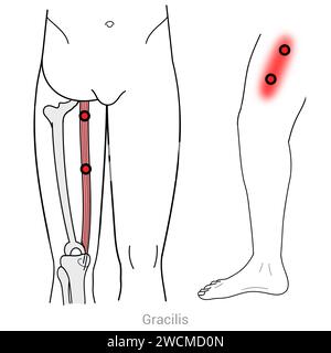 Gracilis : points déclencheurs myofasciaux et localisations douloureuses associées Banque D'Images