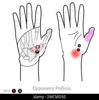 Opponens Pollicis : points déclencheurs myofasciaux et localisations douloureuses associées Banque D'Images