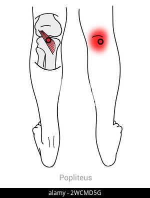 Popliteus : points déclencheurs myofasciaux et localisations douloureuses associées Banque D'Images