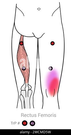 Rectus fémoris : points déclencheurs myofasciaux et localisations douloureuses associées Banque D'Images