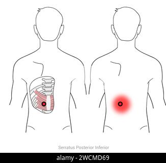 Serratus postérieur inférieur : points déclencheurs myofasciaux et localisations douloureuses associées Banque D'Images