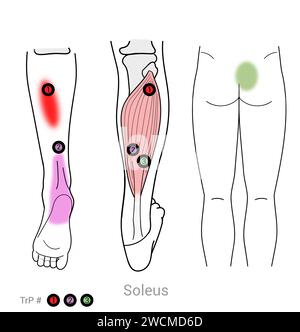 Soléus : points déclencheurs myofasciaux et localisations douloureuses associées Banque D'Images