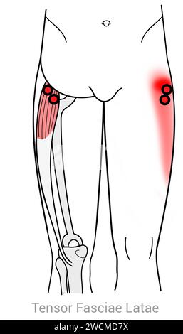 Tensor fasciae latae : points déclencheurs myofasciaux et localisations douloureuses associées Banque D'Images