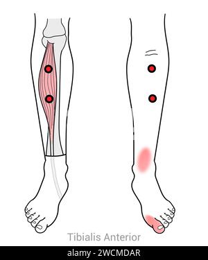 Tibialis antérieur : points déclencheurs myofasciaux et localisations douloureuses associées Banque D'Images