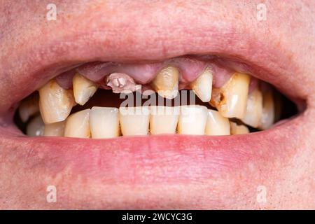 Maladie parodontale, dents lâches dans la bouche de l'homme édenté, gros plan. Problèmes dentaires et traitement orthodontique du patient. Banque D'Images