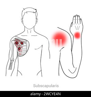 Sous-scapulaire : points déclencheurs myofasciaux et localisations douloureuses associées Banque D'Images