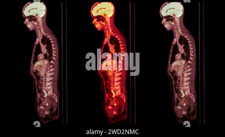 Une image TEP-TDM est une visualisation diagnostique combinant la tomographie par émission de positrons (TEP) et la tomodensitométrie (TDM) pour aider à trouver la cance Banque D'Images