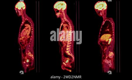 Une image TEP-TDM est une visualisation diagnostique combinant la tomographie par émission de positrons (TEP) et la tomodensitométrie (TDM) pour aider à trouver la cance Banque D'Images