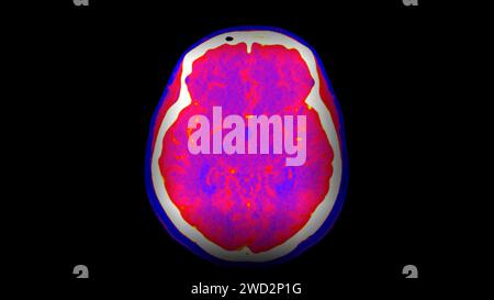 Image CT Brain perfusion ou CT scan de la vue axiale du cerveau . Banque D'Images