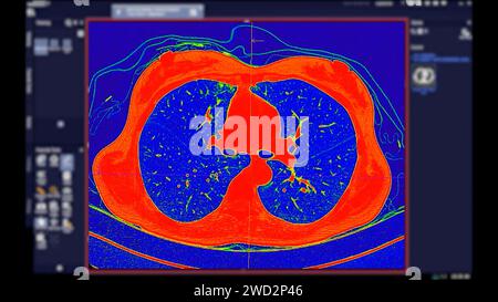 Tomodensitométrie de la vue axiale thorax en mode couleur pour le diagnostic d'embolie pulmonaire (EP) , de cancer du poumon et de covid-19. Banque D'Images