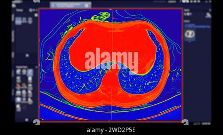 Tomodensitométrie de la vue axiale thorax en mode couleur pour le diagnostic d'embolie pulmonaire (EP) , de cancer du poumon et de covid-19. Banque D'Images