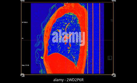 Tomodensitométrie de la vue sagittale thorax en mode couleur pour le diagnostic d'embolie pulmonaire (EP) , de cancer du poumon et de covid-19. Banque D'Images