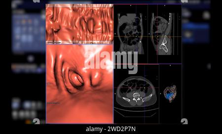 CT colonography , cette technique d'imagerie est souvent utilisée pour le dépistage du cancer colorectal, fournissant des images détaillées de la rendu 3D intérieure du côlon Banque D'Images