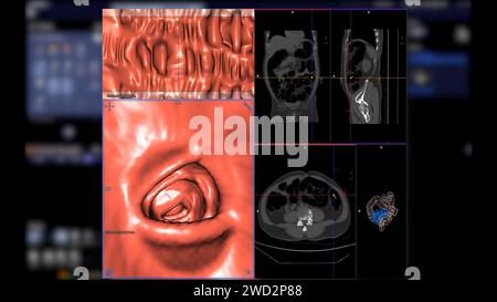 CT colonography , cette technique d'imagerie est souvent utilisée pour le dépistage du cancer colorectal, fournissant des images détaillées de la rendu 3D intérieure du côlon Banque D'Images