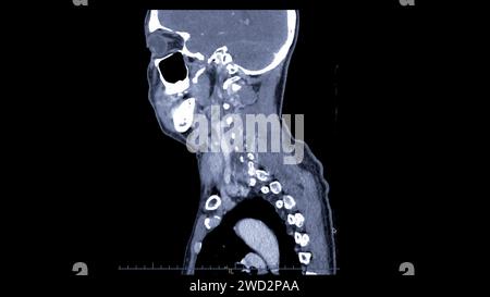 Une tomodensitométrie de la vue sagittale du cou à des fins diagnostiques est essentielle pour évaluer les vertèbres cervicales, les tissus mous et détecter les anomalies Banque D'Images