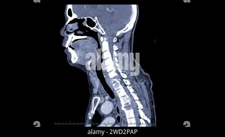 Une tomodensitométrie de la vue sagittale du cou à des fins diagnostiques est essentielle pour évaluer les vertèbres cervicales, les tissus mous et détecter les anomalies Banque D'Images