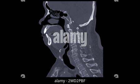 Une tomodensitométrie de la vue sagittale du cou à des fins diagnostiques est essentielle pour évaluer les vertèbres cervicales, les tissus mous et détecter les anomalies Banque D'Images