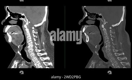 Une tomodensitométrie de la vue sagittale du cou à des fins diagnostiques est essentielle pour évaluer les vertèbres cervicales, les tissus mous et détecter les anomalies Banque D'Images