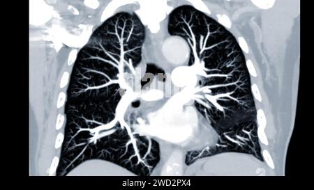 Artère pulmonaire CTPA ou CTA. Cette technique d'imagerie offre une vue claire des artères pulmonaires, facilitant le diagnostic de l'embolie pulmonaire, des canaux Banque D'Images