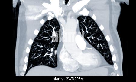 Artère pulmonaire CTPA ou CTA. Cette technique d'imagerie offre une vue claire des artères pulmonaires, facilitant le diagnostic de l'embolie pulmonaire, des canaux Banque D'Images
