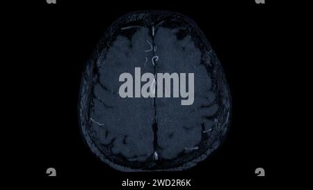 MRA Brain axial View , cette technique d'imagerie fournit des images claires des structures artérielles et veineuses du cerveau, facilitant ainsi le diagnostic du système vasculaire Banque D'Images