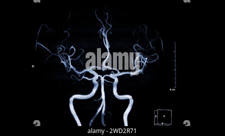 ARM cerveau , cette technique d'imagerie fournit des images claires des structures artérielles et veineuses du cerveau, aidant au diagnostic de l'état vasculaire Banque D'Images