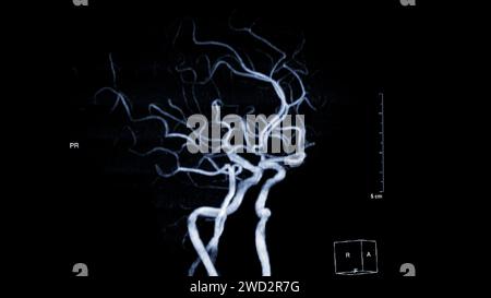 ARM cerveau , cette technique d'imagerie fournit des images claires des structures artérielles et veineuses du cerveau, aidant au diagnostic de l'état vasculaire Banque D'Images