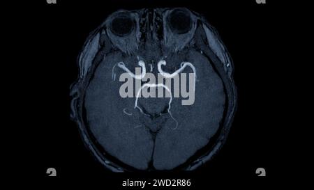 MRA Brain axial View , cette technique d'imagerie fournit des images claires des structures artérielles et veineuses du cerveau, facilitant ainsi le diagnostic du système vasculaire Banque D'Images