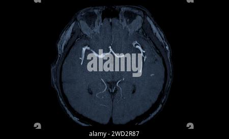 MRA Brain axial View , cette technique d'imagerie fournit des images claires des structures artérielles et veineuses du cerveau, facilitant ainsi le diagnostic du système vasculaire Banque D'Images