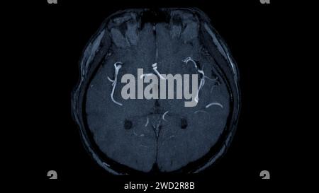 MRA Brain axial View , cette technique d'imagerie fournit des images claires des structures artérielles et veineuses du cerveau, facilitant ainsi le diagnostic du système vasculaire Banque D'Images
