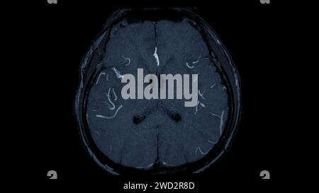 MRA Brain axial View , cette technique d'imagerie fournit des images claires des structures artérielles et veineuses du cerveau, facilitant ainsi le diagnostic du système vasculaire Banque D'Images