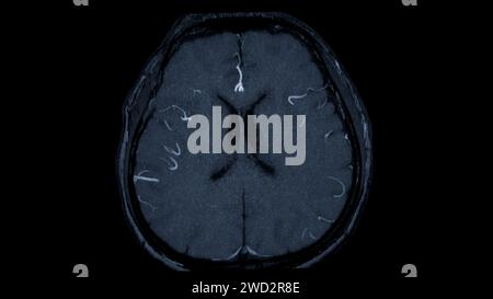 MRA Brain axial View , cette technique d'imagerie fournit des images claires des structures artérielles et veineuses du cerveau, facilitant ainsi le diagnostic du système vasculaire Banque D'Images