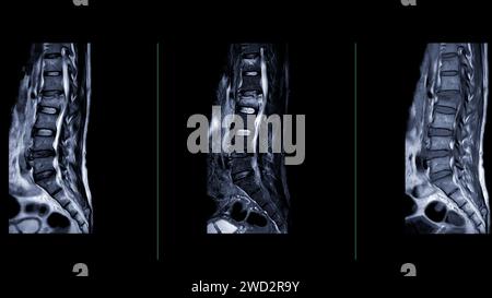 IRM rachis L-S ou rachis lombaire vue sagittale pour le diagnostic de compression médullaire. Banque D'Images