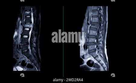 IRM rachis L-S ou rachis lombaire vue sagittale pour le diagnostic de compression médullaire. Banque D'Images