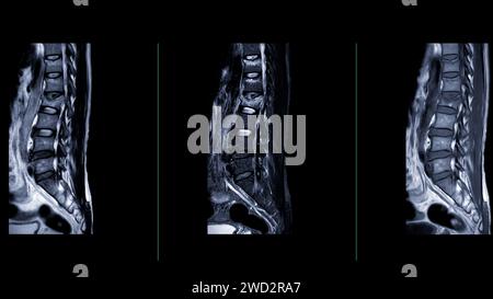 IRM rachis L-S ou rachis lombaire vue sagittale pour le diagnostic de compression médullaire. Banque D'Images