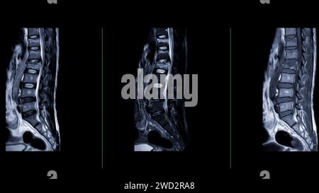 IRM rachis L-S ou rachis lombaire vue sagittale pour le diagnostic de compression médullaire. Banque D'Images