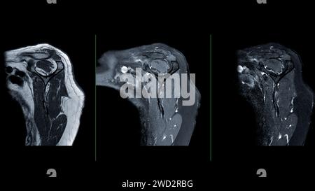 L'IRM de la vue sagittale de l'articulation de l'épaule est une technique d'imagerie non invasive fournissant des informations détaillées sur les structures de l'épaule. pour evalu Banque D'Images