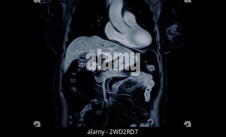 L'IRM de la vue frontale supérieure de l'abdomen est une technique d'imagerie non invasive qui fournit des images détaillées d'organes tels que le foie, le pancréas et les reins. Banque D'Images