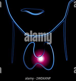 Illustration isolée vectorielle de glande thyroïde avec effet néon. Hypertrophie de la thyroïde. Illustration de Vecteur