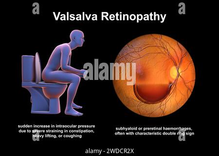 Rétinopathie de Valsava, illustration Banque D'Images