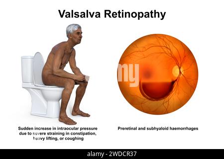 Rétinopathie de Valsava, illustration Banque D'Images