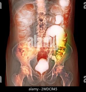 Diverticules du côlon, radiographie Banque D'Images