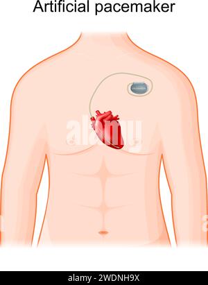 Stimulateur cardiaque artificiel. Coeur humain avec stimulateur cardiaque monochambre. Dispositif médical implanté, qui génère des impulsions électriques délivrées par Elect Illustration de Vecteur