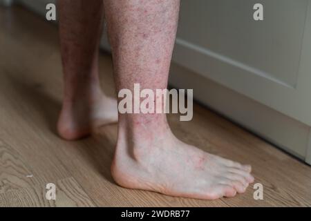 Gros plan de la jambe de l'homme pieds nus sur le sol avec dermatite Rush et irritation rouge sur la peau. Banque D'Images