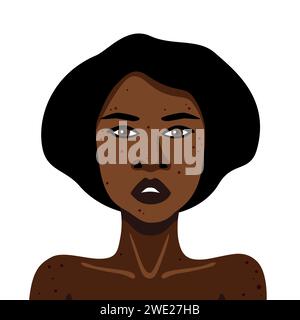 Jeune femme afro-américaine avec acné sur son corps sur une illustration vectorielle de fond blanc dans un style minimaliste Illustration de Vecteur