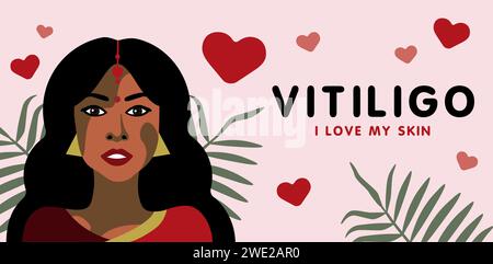 Bannière sur la maladie de peau vitilingo avec la jeune belle femme indienne, illustration vectorielle minimaliste, texte J'aime ma peau Illustration de Vecteur