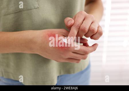 Femme appliquant la crème de guérison sur la main brûlée à l'intérieur, closeup Banque D'Images